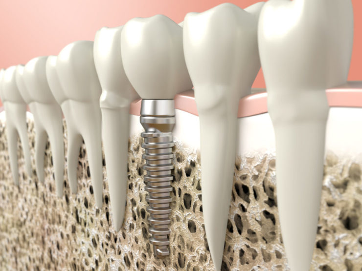 Computer generated image of dental implant